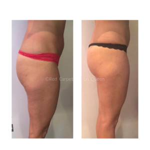 Before and after LPG Lipomassage sessions/treatments to help reduce cellulite, water retention and helps you lose weight.