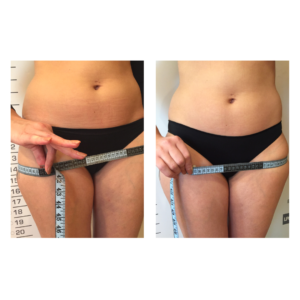 Before and after LPG Lipomassage sessions/treatments to help reduce cellulite, water retention and helps you lose weight.