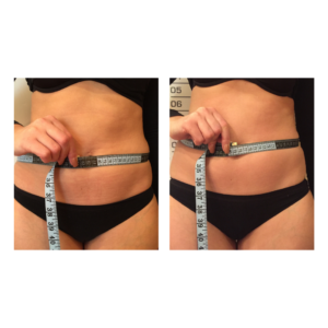 Before and after LPG Lipomassage sessions/treatments to help reduce cellulite, water retention and helps you lose weight.